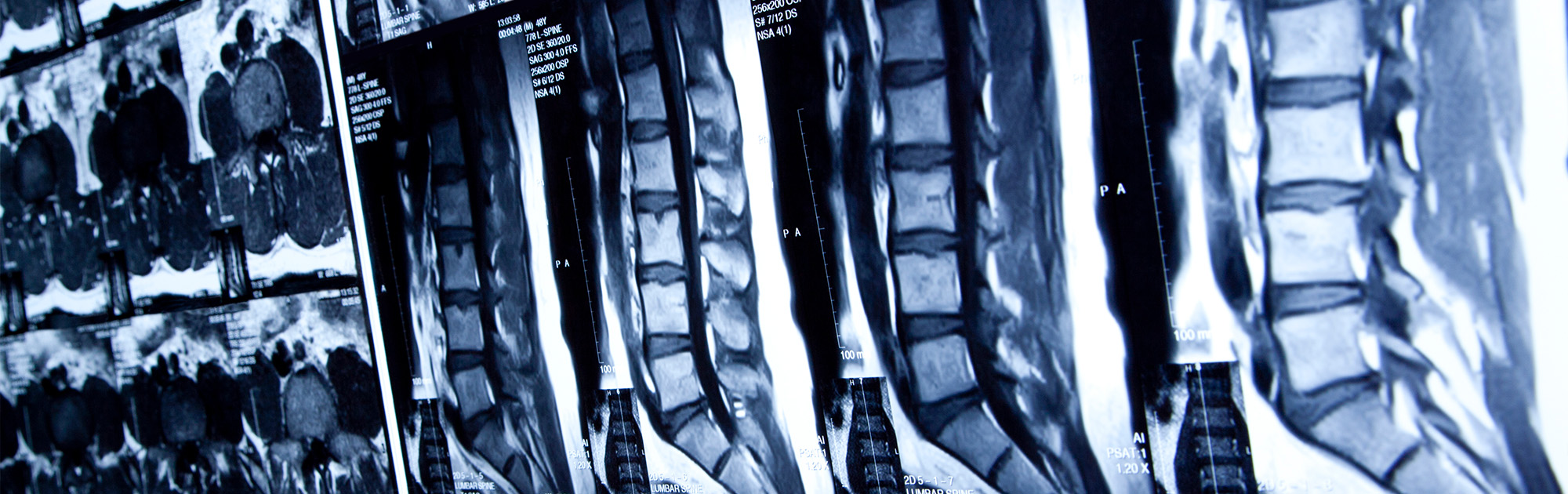 Spinal cord injury lawyers mobile